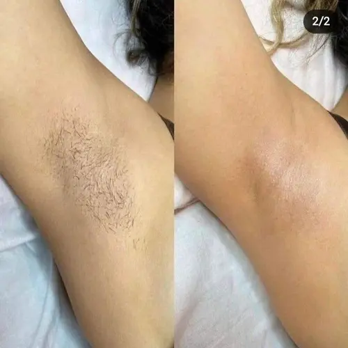 Tratament la SIA Skin Center